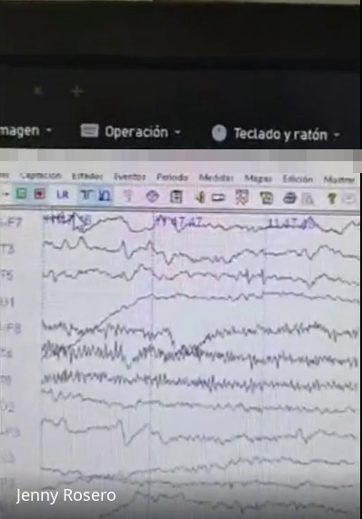 Trazado electroencefalográfico continuo
